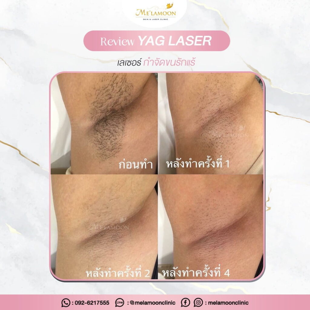 review_hair_removal_002