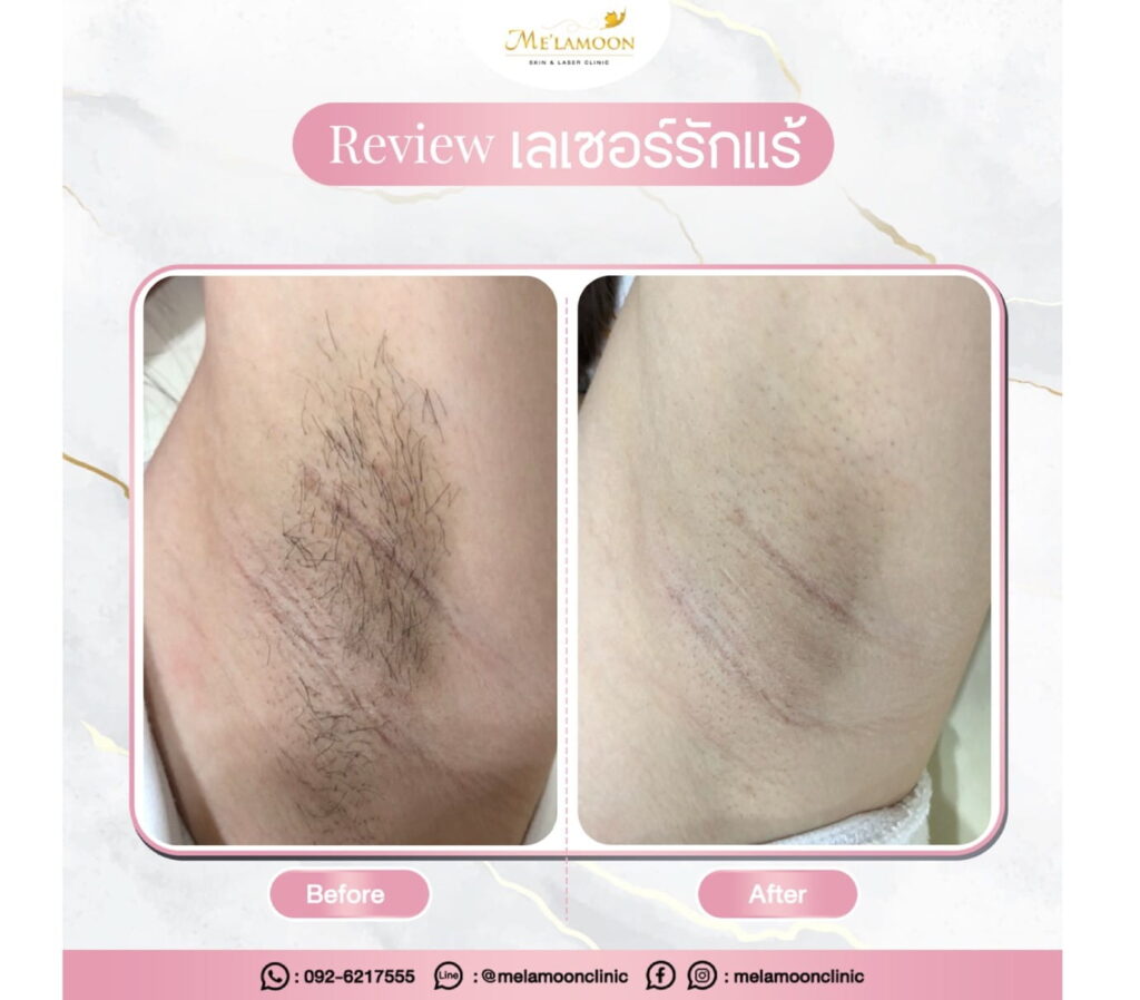 review_hair_removal_004