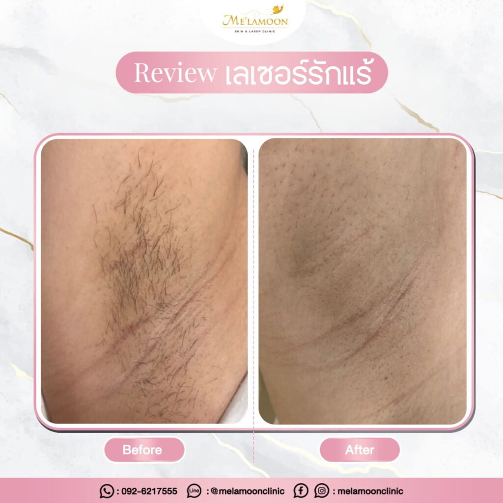 review_hair_removal_005