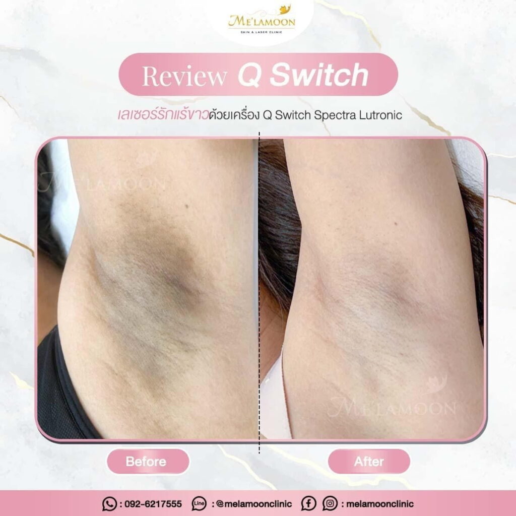 review_hair_removal_006